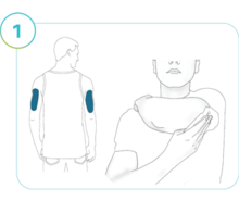 Illustration of Step 1: Application sites highlighted on the back of both arms, an illustration of a person wiping the application site.